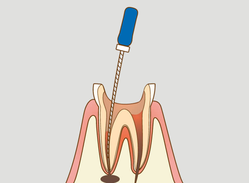 歯髄を取り除く