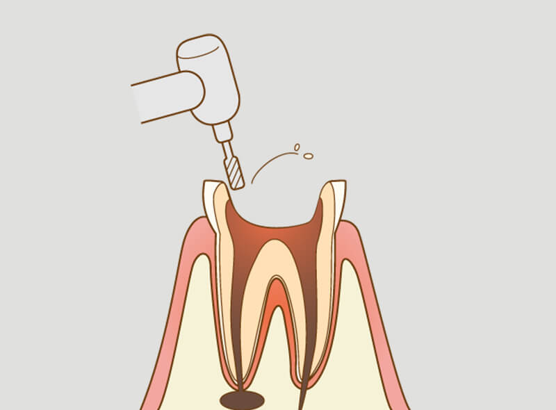 根管の拡大