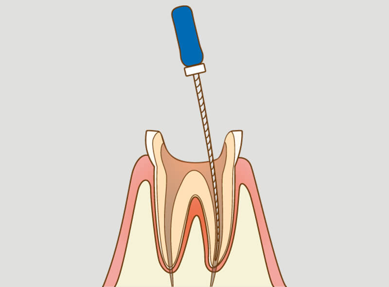 歯の根の消毒