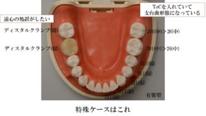 ラバーダム防湿,セミナー,ラバーダム防湿セミナー