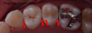 銀歯,むし歯,ラバーダム防湿,マイクロスコープ,歯の詰め物,コンポジットレジン,ダイレクトボンディング