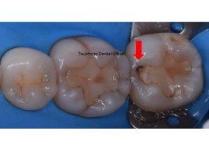 むし歯,ラバーダム防湿,審美歯科治療,ダイレクトボンディング,歯のつめもの,コンポジットレジン