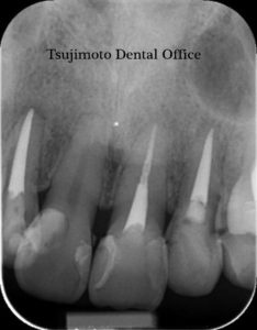 歯の根の治療,神経の治療,根管治療,歯内療法,マイクロスコープ