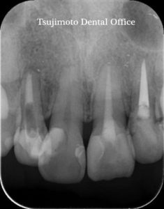 歯の根の治療,神経の治療,根管治療,歯内療法,マイクロスコープ,むし歯,歯のつめもの,ダイレクトボンディング,コンポジットレジン