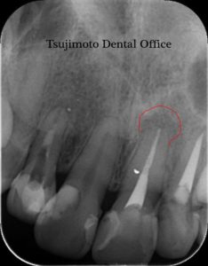 歯の根の治療,神経の治療,根管治療,歯内療法,マイクロスコープ