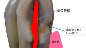 歯の神経・歯ぐき・歯がえぐれている・歯がしみる