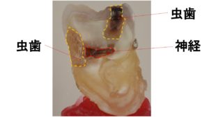 むし歯,歯の神経,