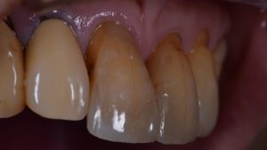 気になる前歯の色 すきっぱ 前歯編 福岡市中央区の歯医者 歯科なら大濠公園駅近くの辻本デンタルオフィスへ 気になる前歯の色 すきっぱ 前歯編 福岡市中央区の歯医者 歯科なら大濠公園駅近くの辻本デンタルオフィスへ