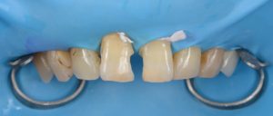 前歯、前歯詰め物、前歯詰め物変色、前歯ダイレクトボンディング、前歯CR、ラバーダム防湿