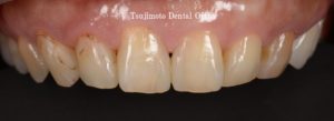 前歯、前歯詰め物、前歯詰め物変色、前歯ダイレクトボンディング、前歯CR