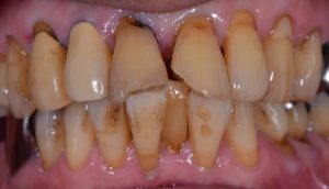 審美歯科、前歯すきっぱ、前歯虫歯、ダイレクトボンディング、CR、コンポジットレジン修復