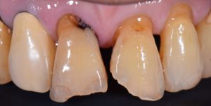 審美歯科、前歯すきっぱ、前歯虫歯、ダイレクトボンディング、CR、コンポジットレジン修復