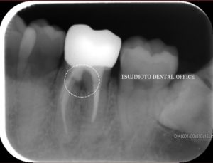 穿孔・パーフォレーション・歯内療法・根管治療・マイクロスコープ