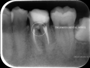 穿孔・パーフォレーション・歯内療法・根管治療・マイクロスコープ