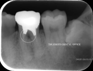 穿孔・パーフォレーション・歯内療法・根管治療・マイクロスコープ