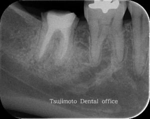 根管治療後のレントゲン写真