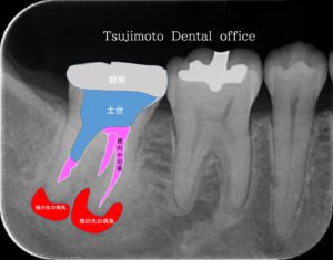 歯の根の先の病気