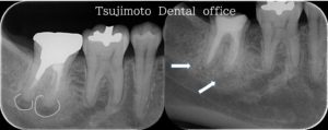 根管治療後のレントゲン写真比較